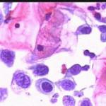 Αδενικά κύτταρα με αρραιοχρωματικούς ανισομεγεθεος πυρήνες, επίχρισμα του 2003